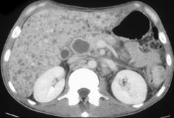 Hepatoma - CTisus CT Scan