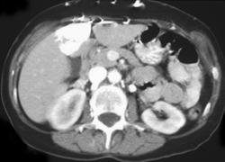 Liver Abscess - CTisus CT Scan