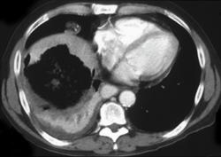 Hepatic Infarct S/P Transjugular Intrahepatic Portosystemic Shunt (TIPS) - CTisus CT Scan