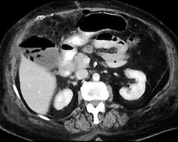 Candidiasis (Angiomyolipoma (AML) Patient) - CTisus CT Scan