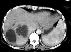 Multifocal Hepatoma - CTisus CT Scan