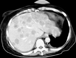 Cholangiocarcinoma - CTisus CT Scan