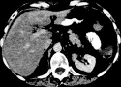 Sickle Cell Disease (dense Liver) - CTisus CT Scan