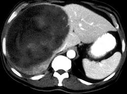 Hepatic Adenoma - CTisus CT Scan