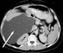 Hepatoma - CTisus CT Scan