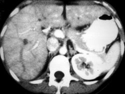 Cholangiocarcinoma - CTisus CT Scan