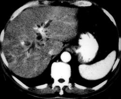 Invasive Gallbladder Cancer - CTisus CT Scan