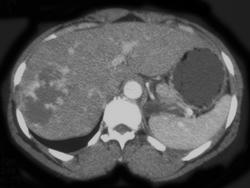 Hemangioma - CTisus CT Scan