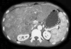 Hepatoma - CTisus CT Scan