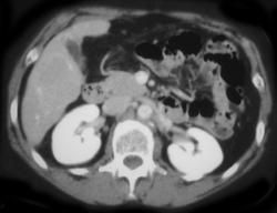 Focal Nodular Hyperplasia (FNH) - CTisus CT Scan