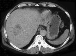 Hepatoma - CTisus CT Scan