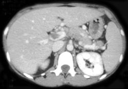 Portal Vein Thrombosis - CTisus CT Scan