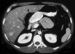 Hepatoma - CTisus CT Scan