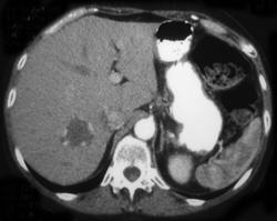 Hemangioma - CTisus CT Scan