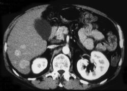 Hepatoma - CTisus CT Scan