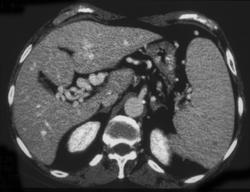 Cavernous Transformation of the Portal Vein - CTisus CT Scan