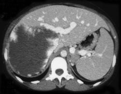 Giant Hemangioma - CTisus CT Scan