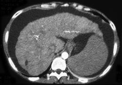 Cirrhosis - CTisus CT Scan