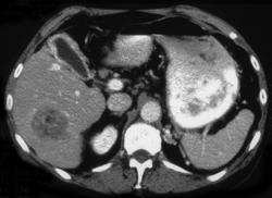 Hepatoma - CTisus CT Scan