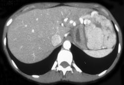 Focal Nodular Hyperplasia - CTisus CT Scan