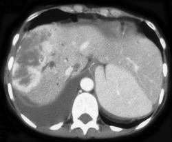 Cholangiocarcinoma - CTisus CT Scan