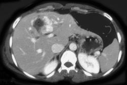 Hemangioma - CTisus CT Scan