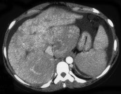 Cirrhosis - CTisus CT Scan