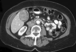 Gallbladder Cancer - CTisus CT Scan