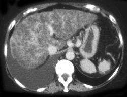 Cirrhosis - CTisus CT Scan