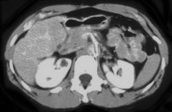 Hepatic Adenoma - CTisus CT Scan