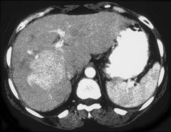 Hepatic Adenoma - Liver Case Studies - CTisus CT Scanning