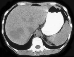 Hepatic Adenoma - CTisus CT Scan