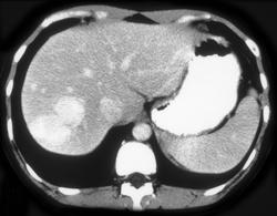 Hepatic Adenoma - CTisus CT Scan