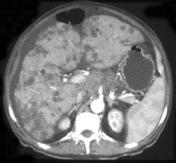 Cirrhosis - CTisus CT Scan