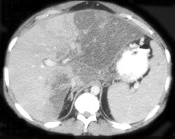 Fatty Liver - CTisus CT Scan