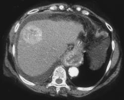 Hepatoma - CTisus CT Scan