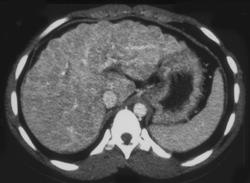 Cirrhosis - CTisus CT Scan