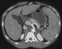 Cirrhosis - CTisus CT Scan