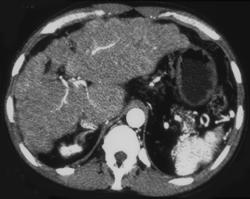 Cirrhosis - CTisus CT Scan