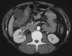 Acute Cholecystitis - CTisus CT Scan