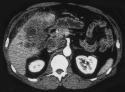 Gallbladder Cancer - CTisus CT Scan