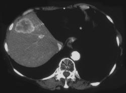 Hepatoma - CTisus CT Scan