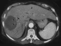 Liver Abscess - CTisus CT Scan