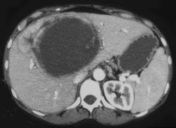 Hepatic Adenoma - CTisus CT Scan