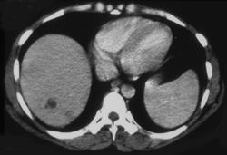 Liver Abscess - CTisus CT Scan