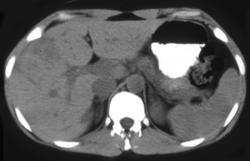 Focal Nodular Hyperplasia (FNH) - CTisus CT Scan