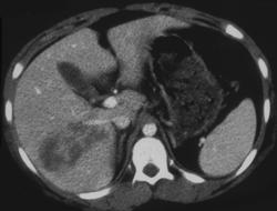 Liver Laceration - CTisus CT Scan