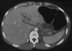 Liver Laceration - CTisus CT Scan