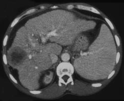 Hepatoma - CTisus CT Scan