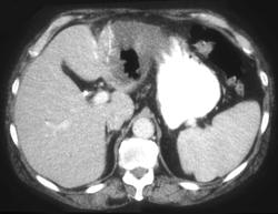 Liver Abscess - CTisus CT Scan